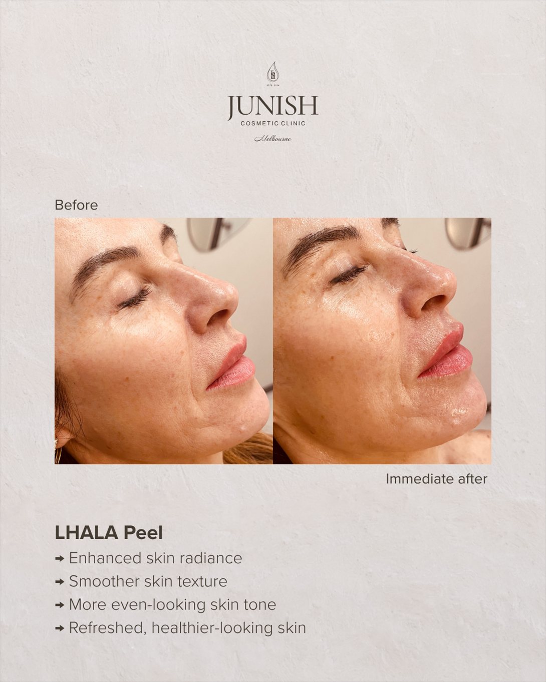 Before and after — LHALA Peel, immediately after treatment