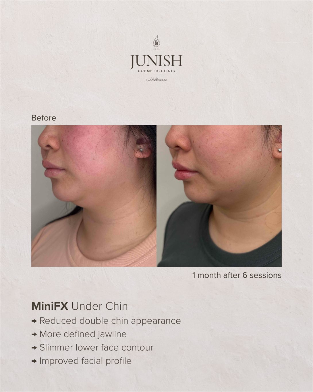 Before and after — MiniFX under chin, one month after six sessions