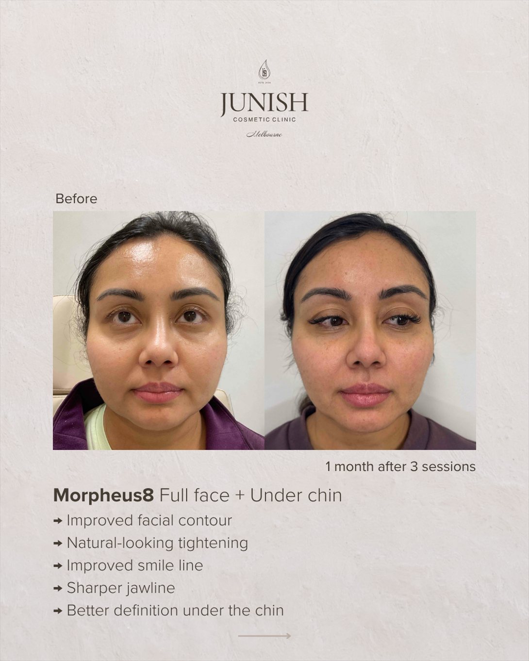 Before and after — Morpheus8 full face and under chin, one month after three sessions