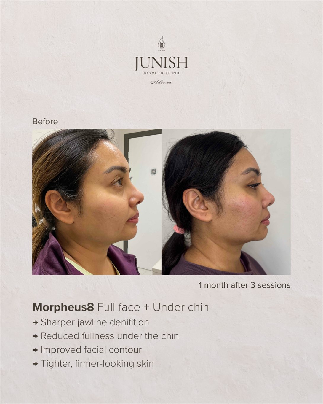 Before and after — Morpheus8 full face and under chin, profile view