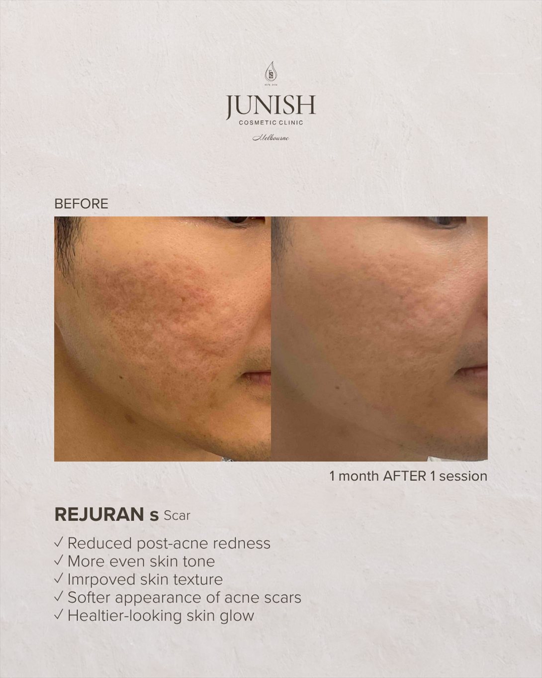 Before and after — REJURAN S for acne scarring, one month after one session
