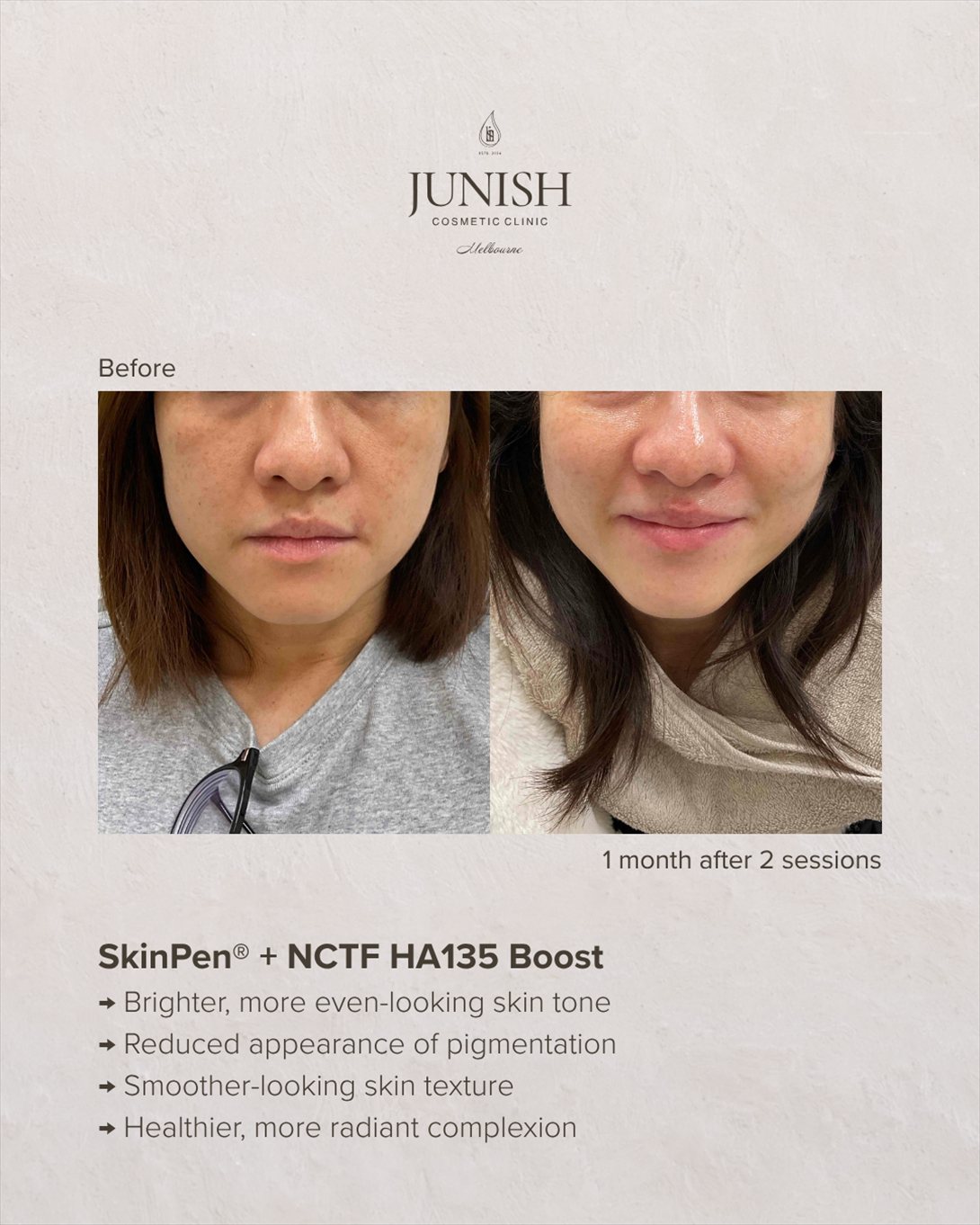 Before and after — SkinPen with NCTF HA135 Boost, one month after two sessions